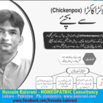 چکن پاکس، لاکڑا کاکڑا کیا ہے اور ہومیوپیتھک علاج کیا۔ حسین قیصرانی