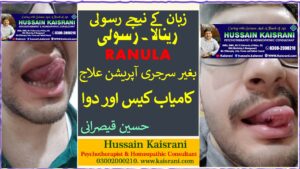 رینولا یعنی زبان کے نیچے رسولی ۔۔ بغیر سرجری آپریشن علاج ۔۔ کامیاب کیس، ہومیوپیتھک علاج ۔ حسین قیصرانی