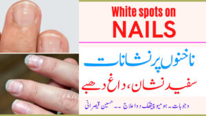 ails Par Sufaid Nishan ka elaaj || Causes White Marks On Nails || Nakhun ke spots ka ilaaj || Urdu Hindi || Hussain Kaisrani