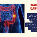 بڑی آنت کا کینسر کتنا خطرناک ہے اور یہ 50 سال سے کم عمر افراد میں عام کیوں ہو رہا ہے؟
