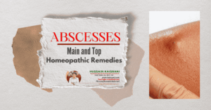 ABSCESSES – Main and Top Homeopathic Remedies