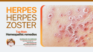 SKIN PROBLEMS: HERPES and HERPES ZOSTER – Top Main Homeopathic remedies