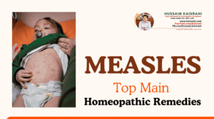 MEASLES – Top Main Homeopathic remedies