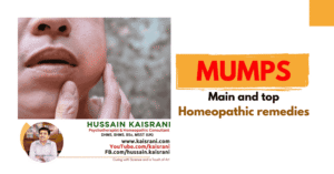 MUMPS – Main and top Homeopathic remedies